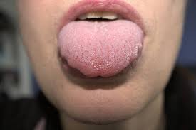 Medical Conditions Associated with a Scalloped Tongue